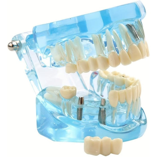 Modelo Didáctico de Implante Dental Flexible, con Dientes Extraíbles y Cavidad Bucal Transparente, Multicolor (Blue)